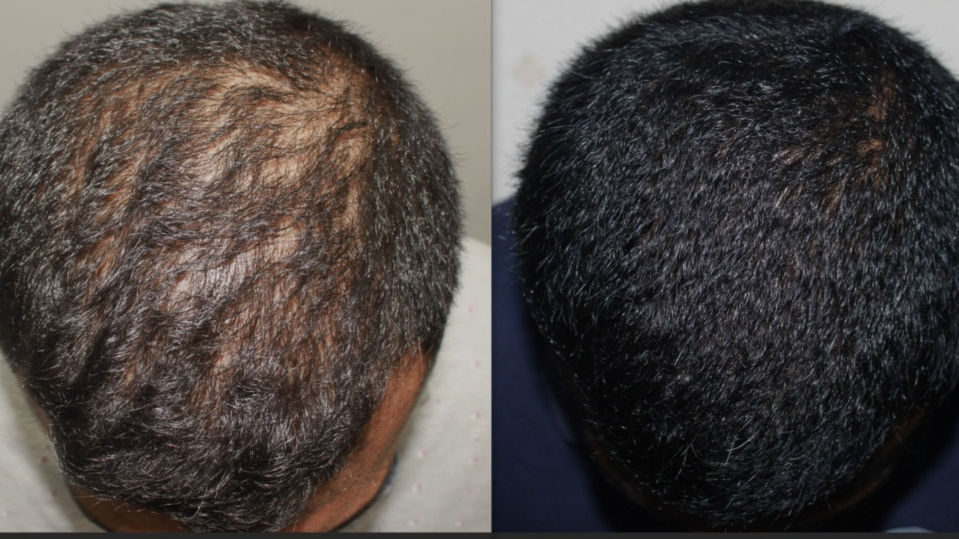 Treatment of male pattern hair loss with medicines & GFC
