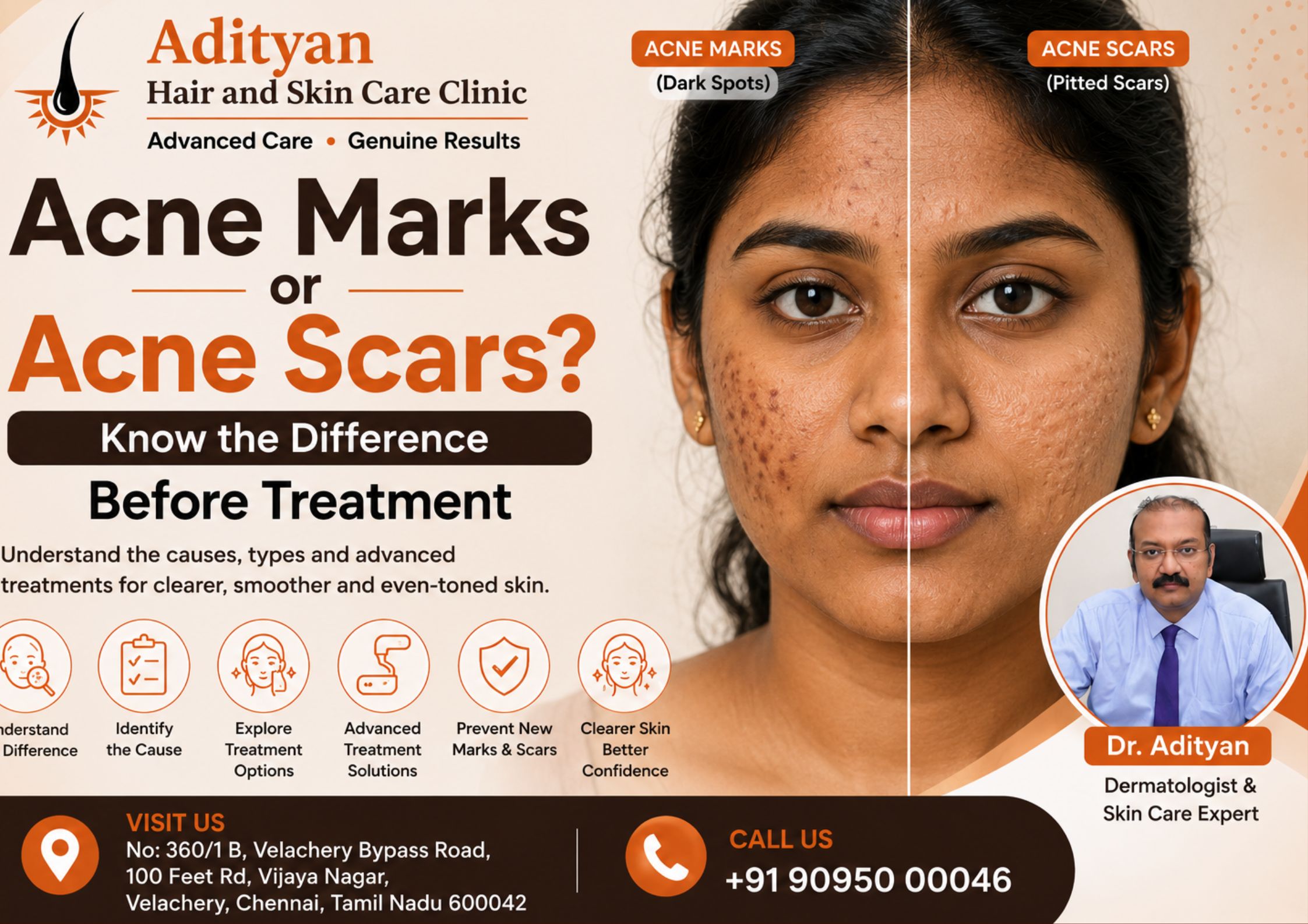 Acne Marks or Acne Scars? Know the Difference Before Treatment